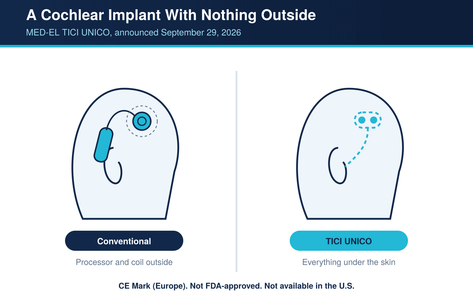 Diagram comparing a conventional cochlear implant with an external processor and coil to the fully implantable TICI UNICO, which sits entirely under the skin